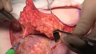 Lateral Intercostal Artery Perforator (LICAP) Flap in Partial Breast Reconstruction