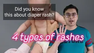 Must know for new parents: 4 types of diaper rashes