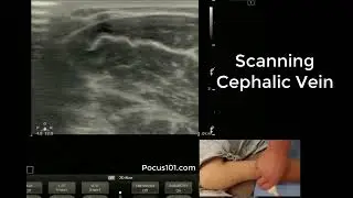 Scanning the Cephalic Vein with Ultrasound