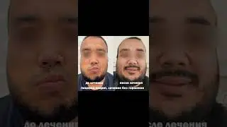 Лицевой неврит, лечение (без гормонов)