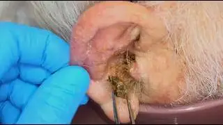 Monster Ear Wax Removal Brings New Life to JOKESTER Patient! | Auburn Medical Group