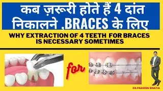 क्योंऔर कब ज़रूरी होते हैं 4 दांत निकालने BRACES के लिए -Extraction of teeth for braces 