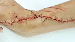 Fresh Stitches Prosthetic