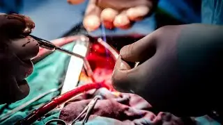 Sutured Patch Repair of Ischemic Left Ventricular Free Wall Rupture