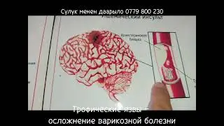 трофический язва