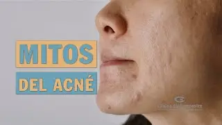 Mitos del acné