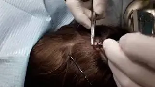 Removal of atheroma on the head with minimization of hair loss