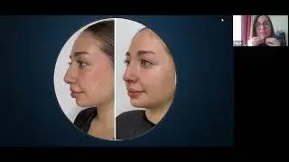 Armonización Facial 3D Mónica VIP