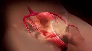 Uterine Fibroid Embolization / Video by Merit Medical Systems