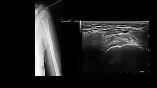 Ultrasound guided  subacromial steroid injection (calcific tendinitis and bursitis)