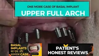 fix your teeth in 72 hours with basal implants-Patient's honest reviews after fixing new teeth