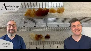 LAYERED, STICKY EAR WAX & HARD WAX & KERATIN PLUG REMOVAL - EP840