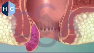 Thrombosed External Hemorrhoid Treatment