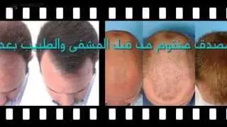 زراعة الشعر في تركيا المشفى الاولى في العالم للحجز 00905555558555