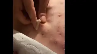 **Crazy** Pimple Popping Compilation | Satisfying Pops