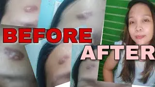 PAANO NAWALA ANG PIMPLES KO? / PAANO MAWALA ANG PIMPLES / TURMERIC TEA
