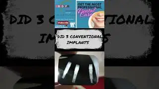 Step-by-Step Placement of Molar Conventional Dental Implants WITH OPG