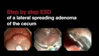Step by step ESD at the cecum