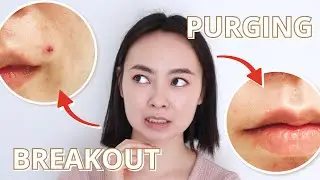 Breakout vs. Purging – I’ve Had Both (With Pictures)