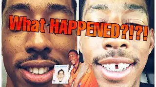What Happened to Your teeth?! 7 weeks post SARPE Surgery