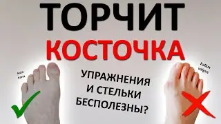 Торчит КОСТОЧКА на ноге. Почему упражнения и стельки вас НЕ СПАСУТ? Как избежать операции?