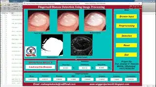 Fingernail Disease Detection Using Image Processing Source Code Fingernail Disease Detect MatlabCode