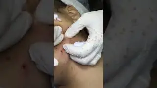 Removendo CRAVOS GRANDES do rosto 😨😮 - satisfatório