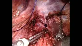 Robotic Anal Sphincter Repair (RASeR Procedure)