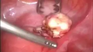Láseres Fotona - Miomectomía laparoscópica con Nd:YAG QCW