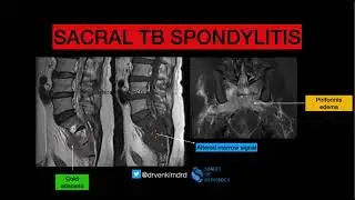Classic example of SACRAL TB