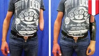 Mind-controlled prosthetic arm: new procedure allows patients to use advanced robotic arm