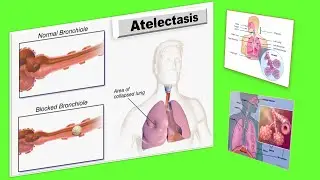 What is Atelectasis and how is it Treated?