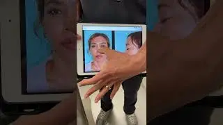 Discussing 2-Month Post-Op Ethnic Rhinoplasty Results | Anthony Bared, MD, FACS Miami, FL