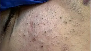 [ASMR] Deep Cleansing Techniques for Blackheads Removal and Acne Relief
