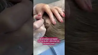 Очаговая алопеция 