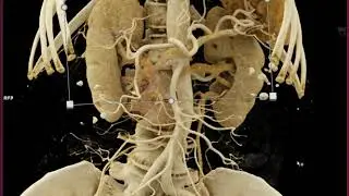 Pancreatic Cancer with Preop Staging with Cinematic Rendering
