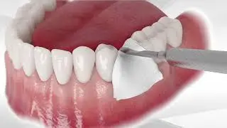 Bond Apatite protocol for socket grafting without flap reflection