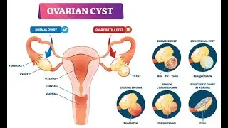 Ovarian Cyst (Urdu/Hindi)