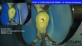 Post & Core build-up