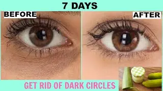 How To Remove Dark Circles Under Eyes At Home | DIY Dark Circle Treatment