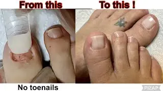 POLYGEL & Dual Forms On Toes with NO NAILS- Get a Quick Natural Look !