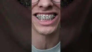don't eat these 3 things with braces