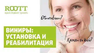 Установка виниров для зубов. Ответы на вопросы по зубным винирам. Часть 2