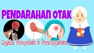 Waspada !!! Pendarahan Pada Otak Bisa Terjadi Pada Siapapun