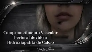 Comprometimento Vascular Perioral devido à Hidroxiapatita de Cálcio