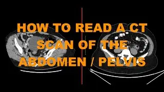 How to read a CT abdomen pelvis scan - introduction to abdominal imaging for junior doctors