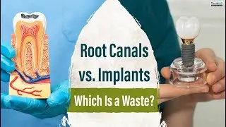 Root Canals vs. Implants: Which Is a Waste?