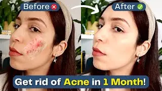 Clear Skin in 30 Days: Natural Acne Treatment