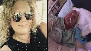 Woman Burned