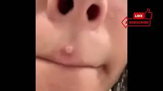 Big Pimple Poping Satisfying 2022